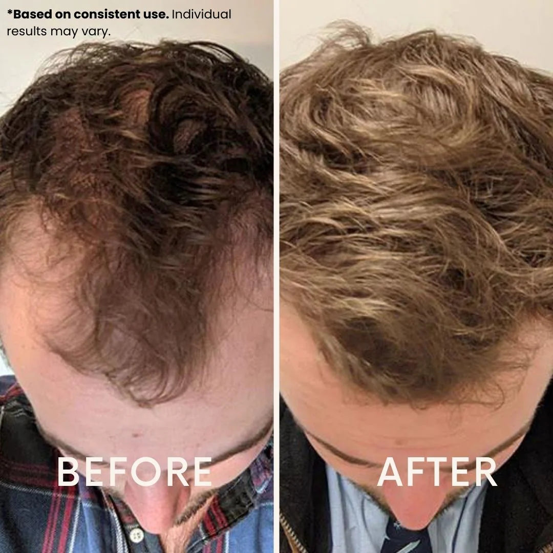 Ledoche | Hairrevive Dual Red Light Therapy Hat