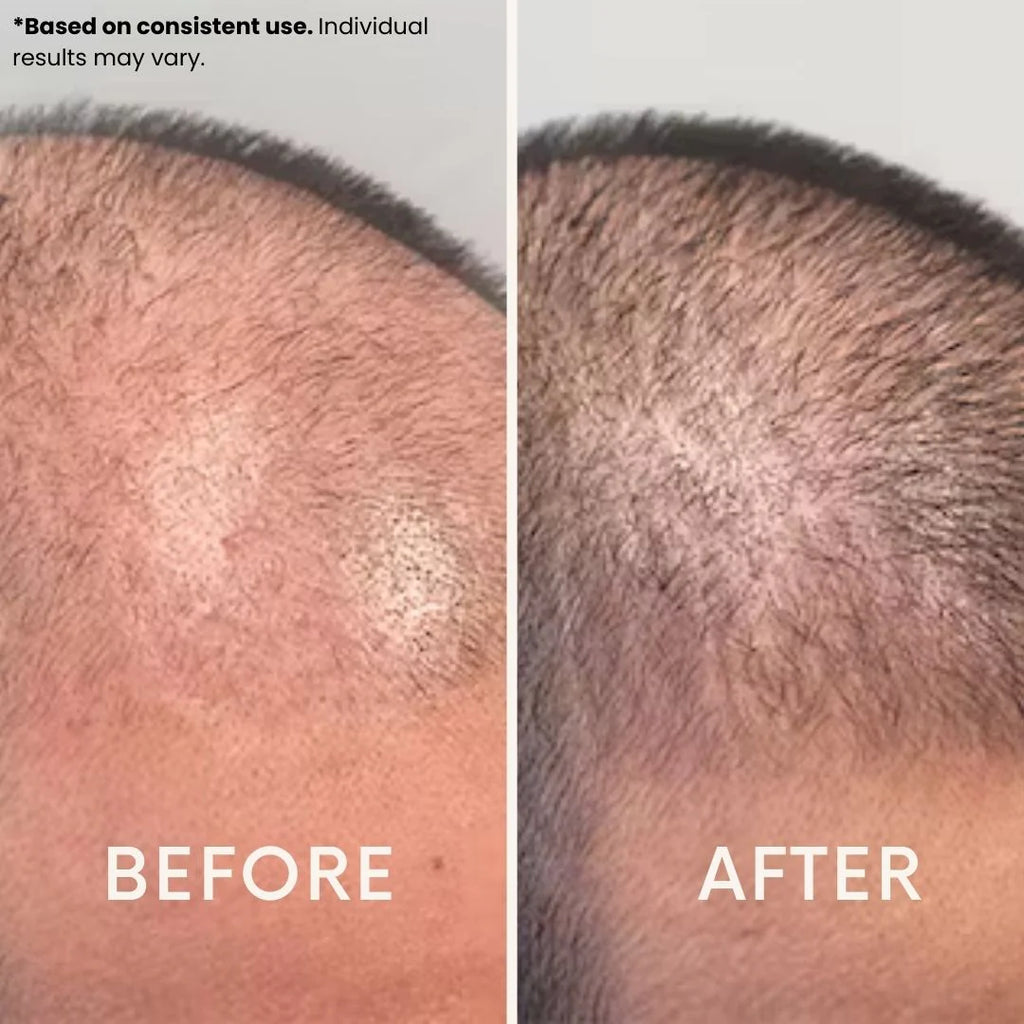 Ledoche | Hairrevive Dual Red Light Therapy Hat