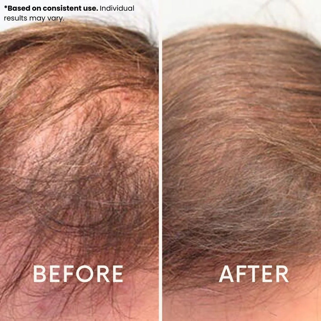 Ledoche | Hairrevive Dual Red Light Therapy Hat