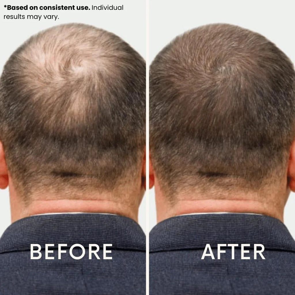 Ledoche | Hairrevive Dual Red Light Therapy Hat