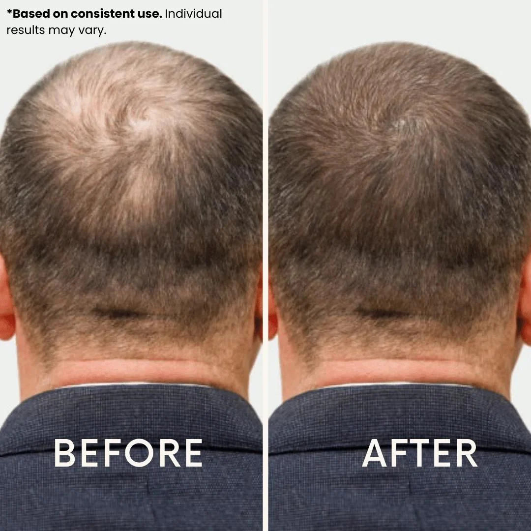 Ledoche | Hairrevive Dual Red Light Therapy Hat