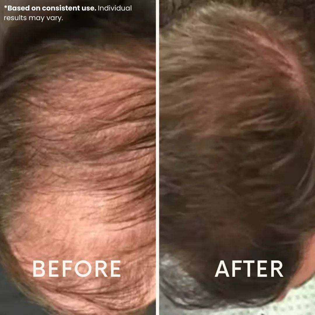 Ledoche | Hairrevive Dual Red Light Therapy Hat